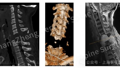 全球罕見！中國醫(yī)生救回“身首離斷”患者