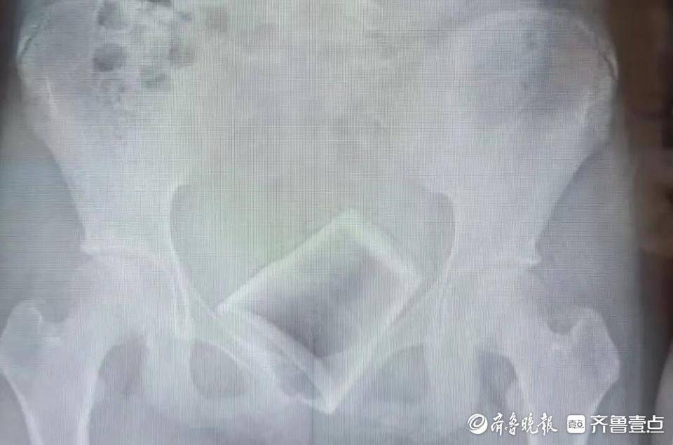 12歲男孩下體插著電線就診！醫(yī)生：這些尿道異物要注意
