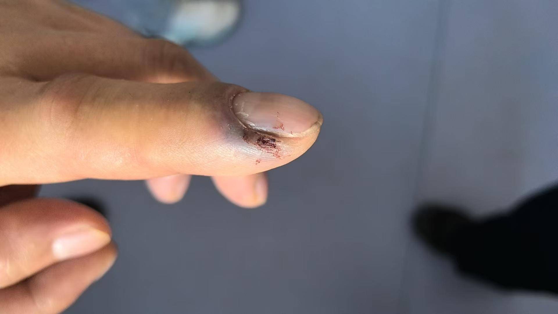 青海一男子被罕見劇毒阿拉善蝮蛇咬傷，因無血清一度想放棄治療 警車開道轉(zhuǎn)運(yùn)700公里救命