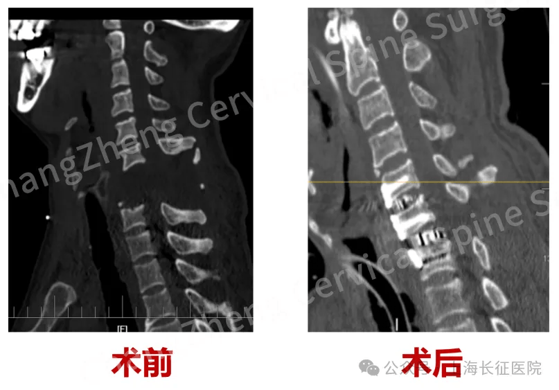 全球罕見！中國醫(yī)生救回“身首離斷”患者