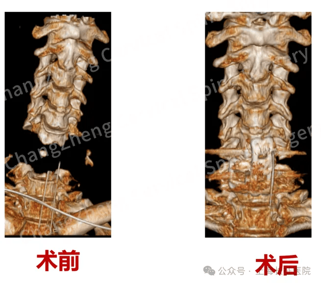 全球罕見！中國醫(yī)生救回“身首離斷”患者